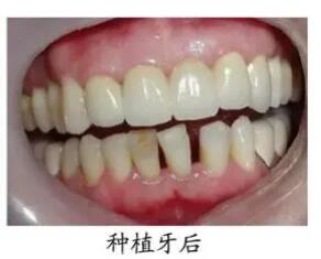 上海圣贝口腔门诊王申牙齿种植真人正案例分享