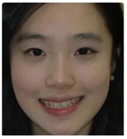 北京圣贝口腔门诊部刘兰忠牙齿矫正真人正案例分享