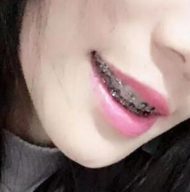 广州好大夫口腔门诊部邓宏亮牙齿矫正案例