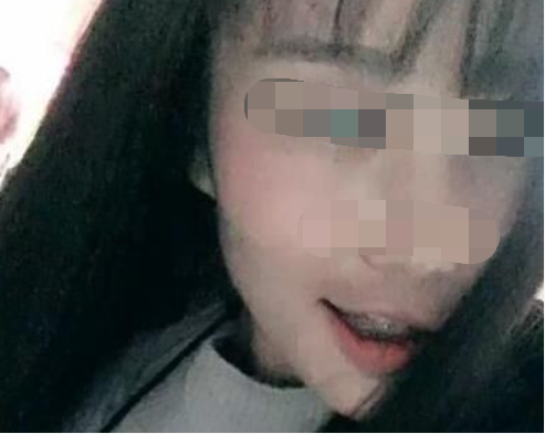 广州好大夫口腔门诊部邓宏亮牙齿矫正案例