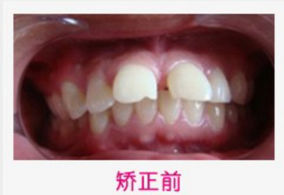 长沙市口腔医院吴昊做牙齿矫正案例分享
