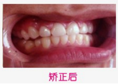 长沙市口腔医院吴昊做牙齿矫正案例分享