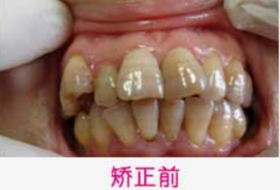 长沙市口腔医院徐树森牙齿矫正案例介绍