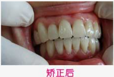 长沙市口腔医院徐树森牙齿矫正案例介绍