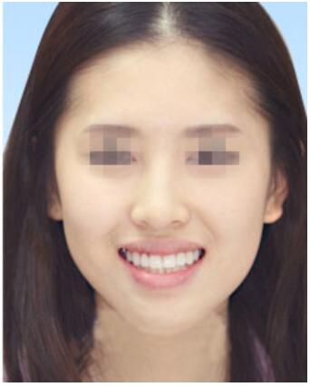 北京协和医院口腔科赖钦声牙齿矫正真人案例分享