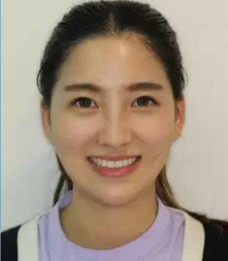 北京协和医院口腔科万阔牙齿矫正真人案例分享
