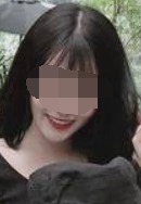 广州华美口腔杨金志牙齿贴面案例分享