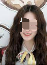 广州华美口腔杨金志牙齿贴面案例分享