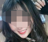广州阳光树口腔岑志平牙齿矫正真人案例分享