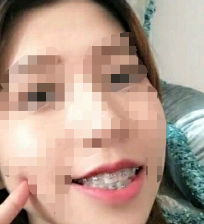 广州壹加壹口腔戚志锋牙齿矫正真人案例分享