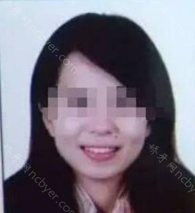 上海美奥口腔医院邓燕牙齿矫正案例分享