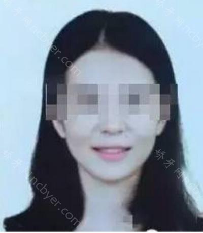 上海美奥口腔医院邓燕牙齿矫正案例分享