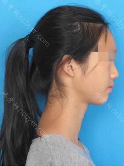 上海美奥口腔医院邓燕牙齿矫正案例术前术后效果分享