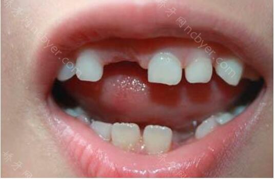 上海雅悦口腔医院吴圣辉牙齿种植案例展示