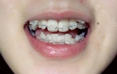 杭州齐尔口腔门诊柯可做牙齿矫正术前术后对比介绍