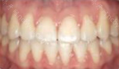 杭州齐尔口腔门诊吴叶群做牙齿矫正案例术前术后分享