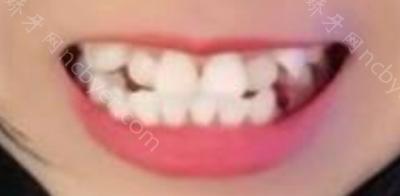 杭州植得口腔门诊高致做牙齿矫正案例介绍