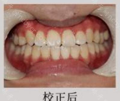 杭州植得口腔门诊高致做牙齿矫正案例对比
