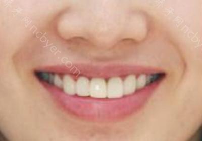 杭州余杭口腔医院李德芳做牙齿种植术前术后分享