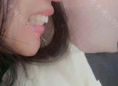 杭州余杭口腔医院宋宇涵做牙齿矫正术前后对比案例