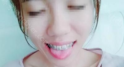 杭州维恩维可口腔诊所陈瑶做牙齿矫正案例分享