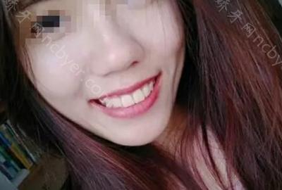 杭州维恩维可口腔诊所陈瑶做牙齿矫正案例分享