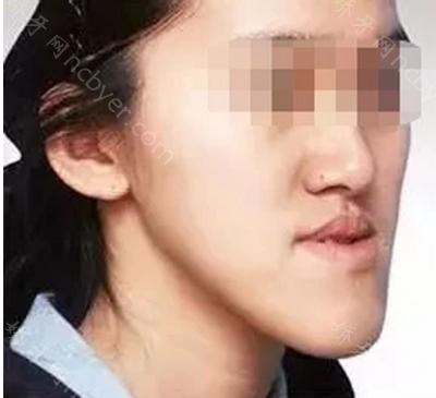 杭州市口腔医院程曼曼做反颌矫正案例分享