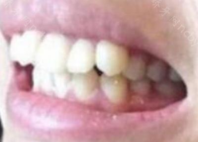 杭州市口腔医院李靖敏做牙齿矫正的案例分享