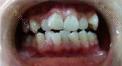 杭州格莱美口腔医院蓝海慧做牙齿矫正的术前后照片分享