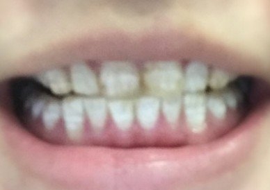巴中青诚口腔医院怎么样？附案例分析和价格表