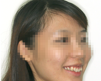 杭州口腔医院义乌分院好不好？_内附牙齿矫正案例分享_牙齿矫正价格表