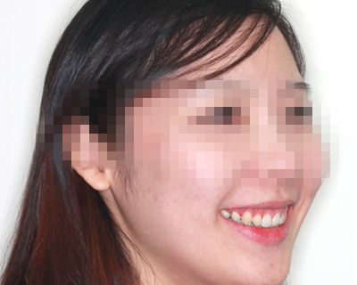 杭州口腔医院义乌分院好不好？_内附牙齿矫正案例分享_牙齿矫正价格表