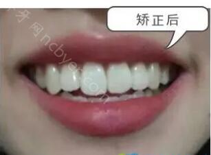 上海新华医院口腔科陆永健做牙齿矫正案例分享