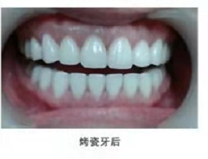 烤瓷牙是什么意思？内含价格表及案例分析