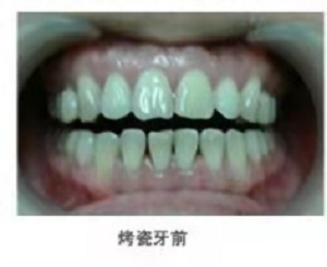 烤瓷牙是什么意思？内含价格表及案例分析