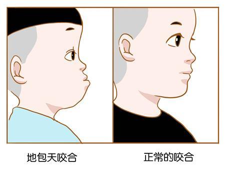 地包天矫正前后对比照片-地包天矫正会有什么影响吗