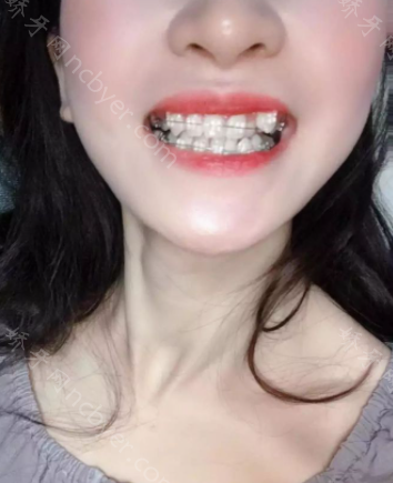 福州同道口腔医院陈树华牙齿矫正真人案例分享