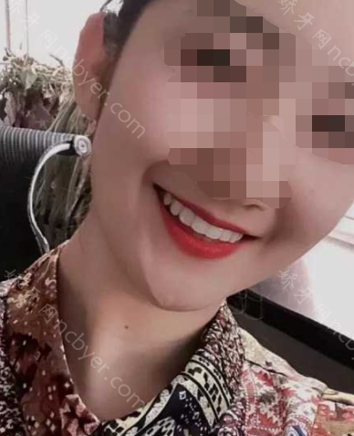福州同道口腔医院陈树华牙齿矫正真人案例分享