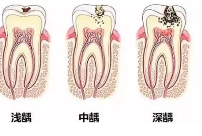 浅龋怎么治疗？浅龋可以不治疗吗？龋齿治疗费用大概多少？