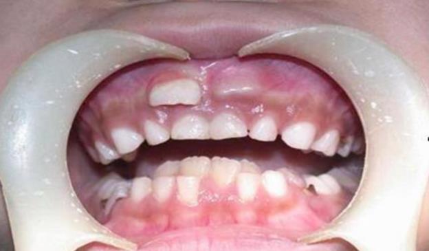 多生牙是什么原因？多生牙怎么办才好？