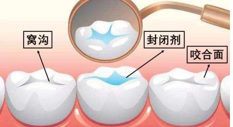 窝沟封闭多少钱？窝沟封闭费用受那些因素影响？窝沟封闭效果维持多久？