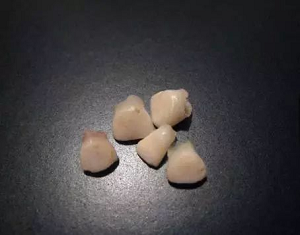 乳牙滞留的危害？内含价格表及案例分析