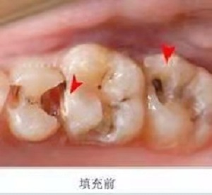国产全瓷牙怎么样？内含价格表及案例分析
