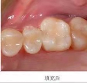 国产全瓷牙怎么样？内含价格表及案例分析