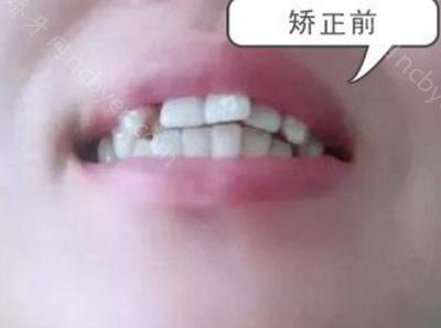 杭州师范大学附属医院口腔科胡旭做隐形牙齿矫正案例对比