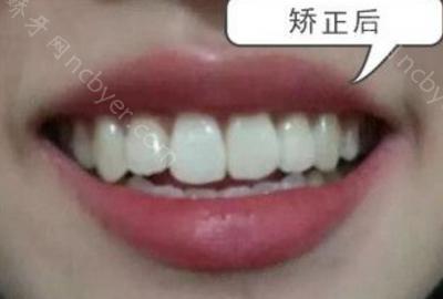 杭州师范大学附属医院口腔科胡旭做隐形牙齿矫正案例对比