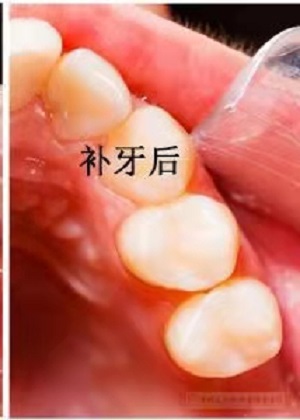 北京补牙费用大概多少？内含价格表及案例分析