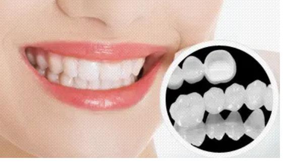 全瓷牙可以用一辈子吗？揭秘全瓷牙的使用寿命！