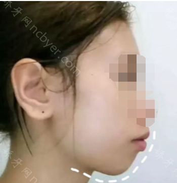福州三栗鼠口腔门诊部王玉钏牙齿正畸+瓷贴面真人案例展示