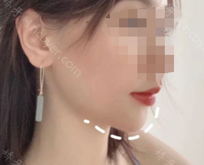 福州三栗鼠口腔门诊部王玉钏牙齿正畸+瓷贴面真人案例展示